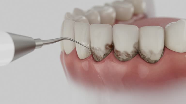 Trusted Wisdom Tooth Removal service in Spencer, WV - Dentist Open Now